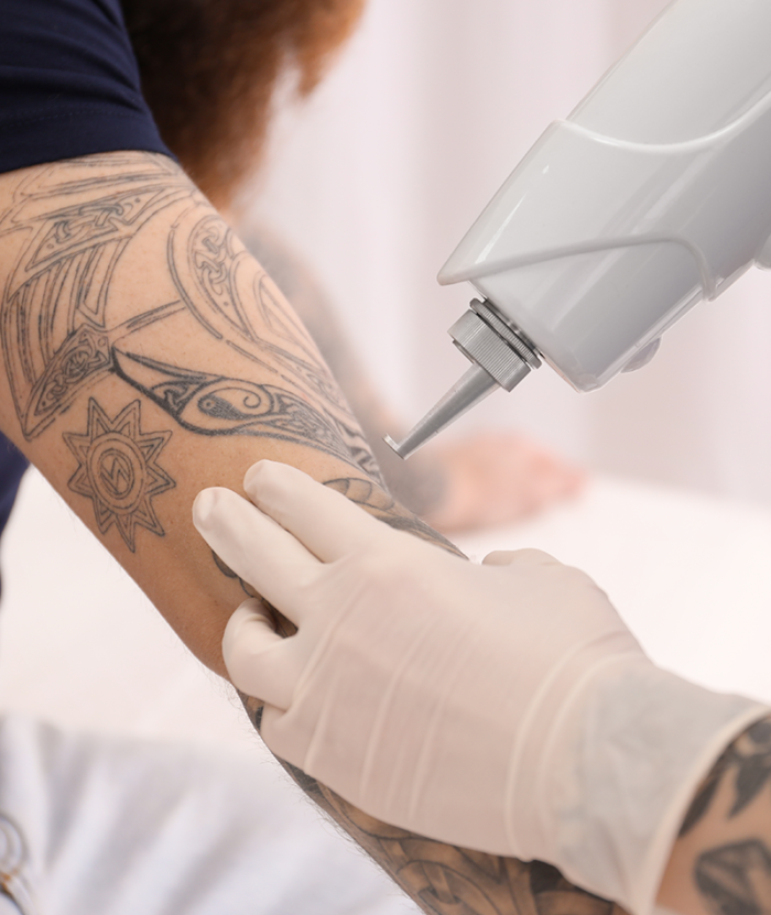 Laser Tattoo Removal | Skin Deep Midtown Med Spa.