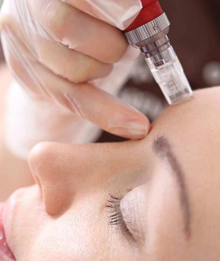 Microneedling | Skin Deep Midtown Med Spa.