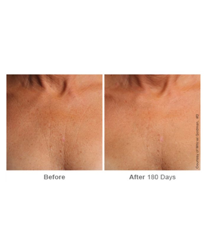 Ultherapy Skin Tightening | Skin Deep Midtown Med Spa.