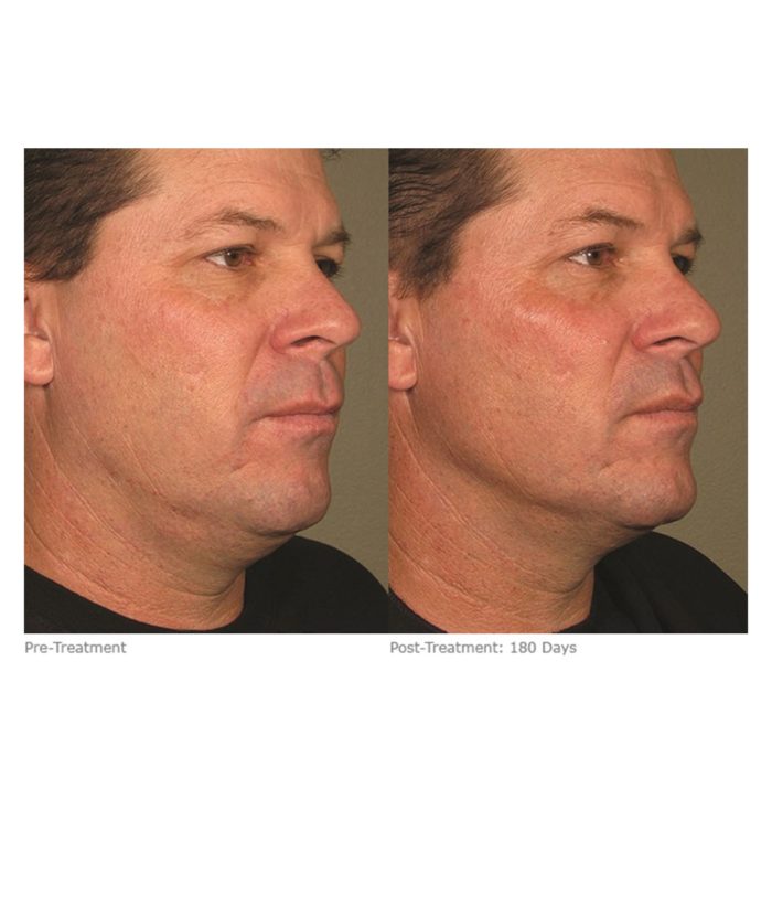 Ultherapy Skin Tightening | Skin Deep Midtown Med Spa.