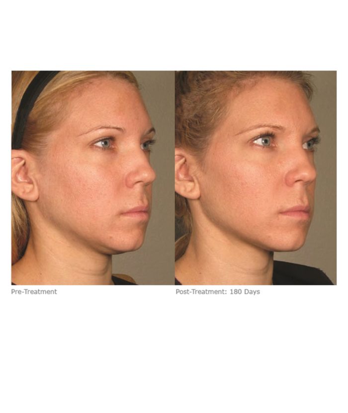 Ultherapy Skin Tightening | Skin Deep Midtown Med Spa.