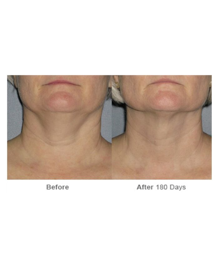 Ultherapy Skin Tightening | Skin Deep Midtown Med Spa.