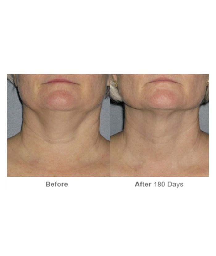 Ultherapy Skin Tightening | Skin Deep Midtown Med Spa.