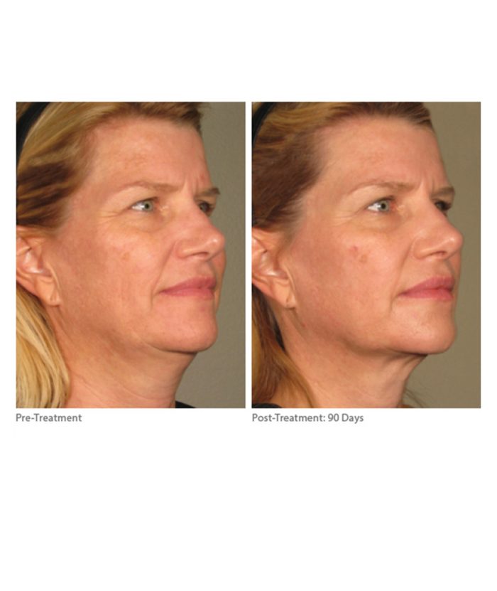 Ultherapy Skin Tightening | Skin Deep Midtown Med Spa.