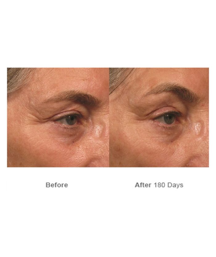 Ultherapy Skin Tightening | Skin Deep Midtown Med Spa.