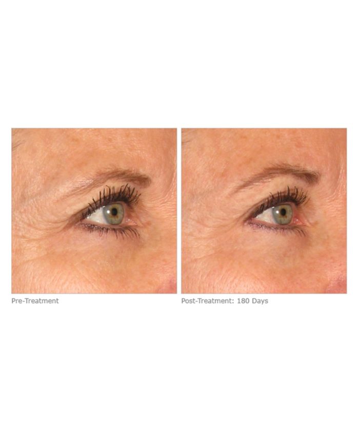 Ultherapy Skin Tightening | Skin Deep Midtown Med Spa.