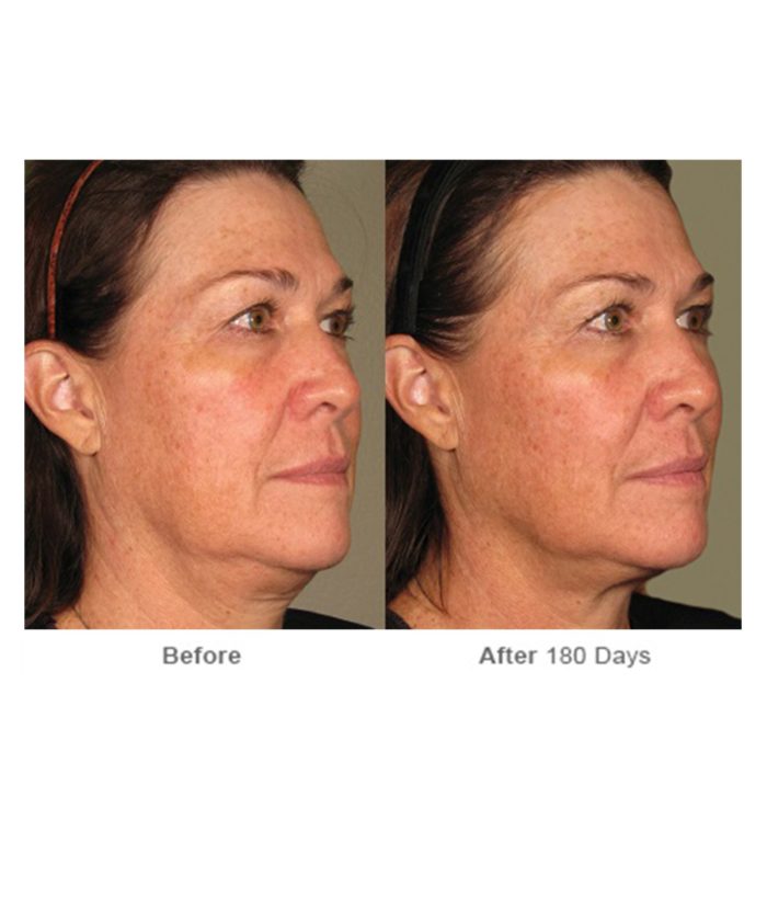 Ultherapy Skin Tightening | Skin Deep Midtown Med Spa.