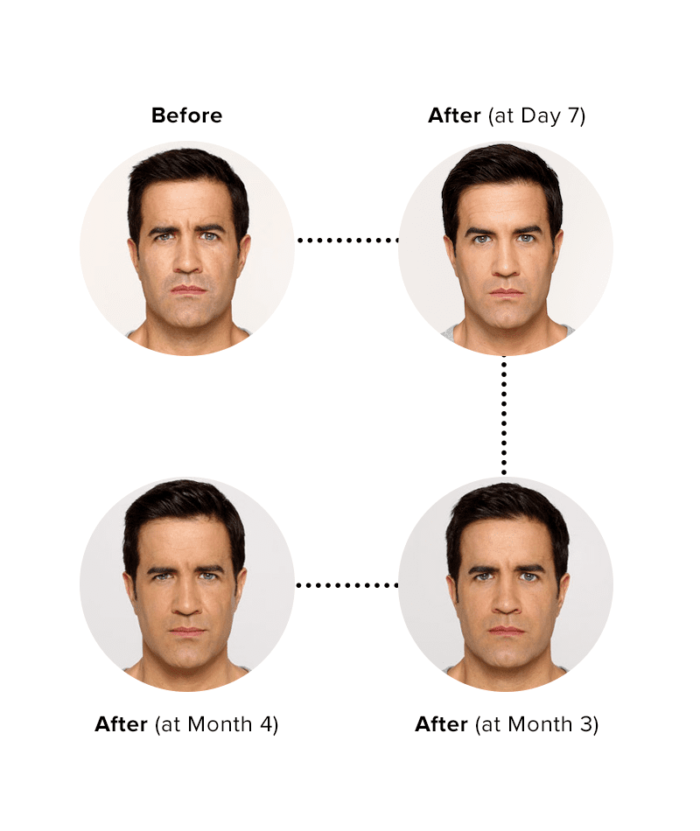 Botox Injections Per Unit | Skin Deep Midtown Med Spa.