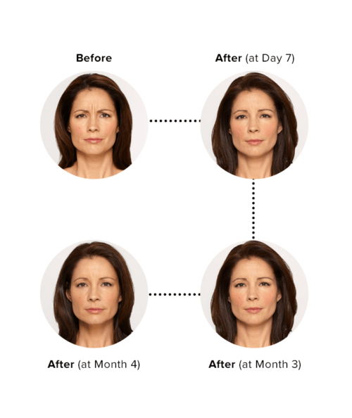 Botox Injections Per Unit | Skin Deep Midtown Med Spa.