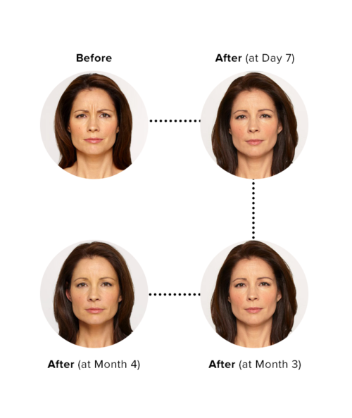 Copy of Botox Injections Per Unit | Skin Deep Midtown Med Spa.