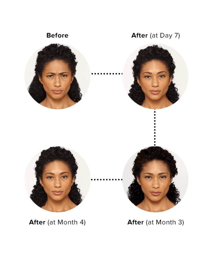 Botox Injections Per Unit | Skin Deep Midtown Med Spa.