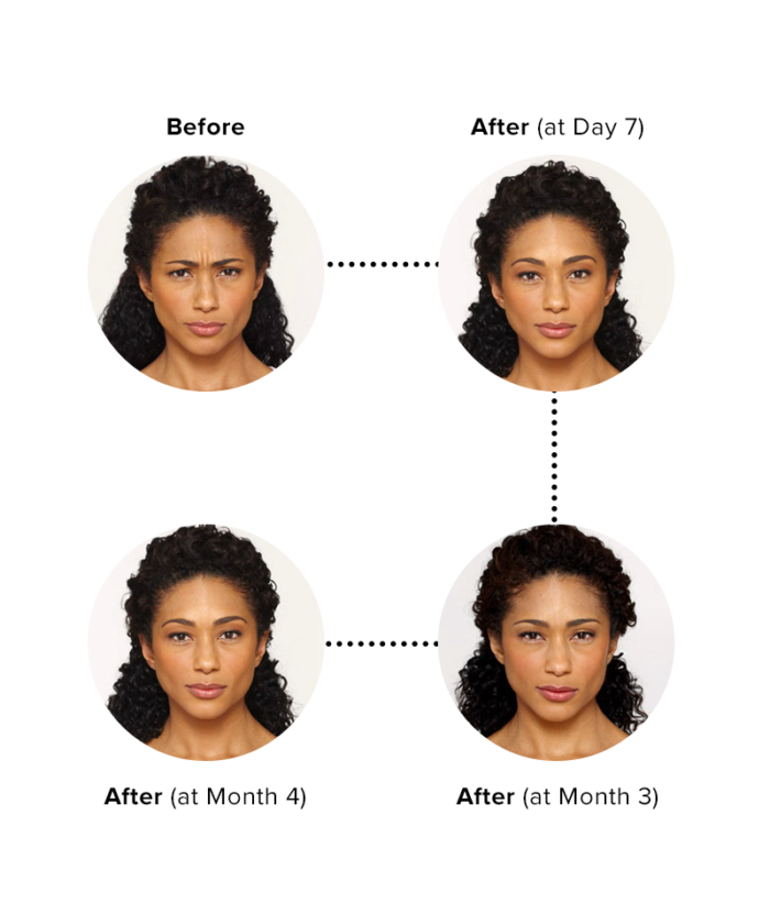 Copy of Botox Injections Per Unit | Skin Deep Midtown Med Spa.