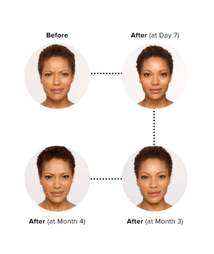Botox Injections Per Unit | Skin Deep Midtown Med Spa.