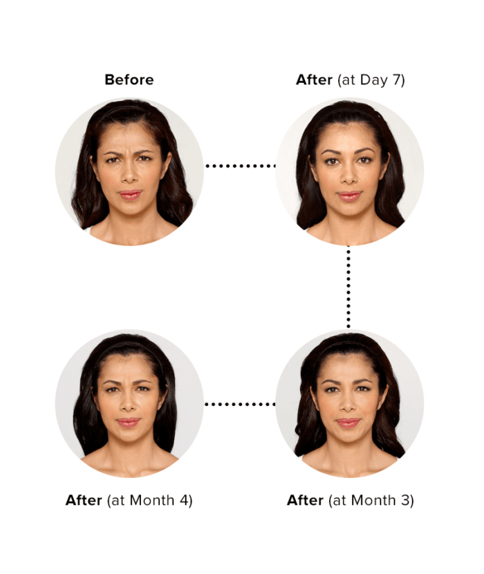 Botox Injections Per Unit | Skin Deep Midtown Med Spa.