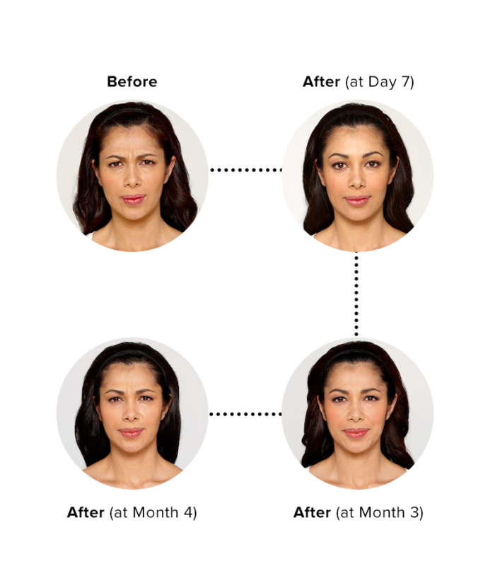 Copy of Botox Injections Per Unit | Skin Deep Midtown Med Spa.