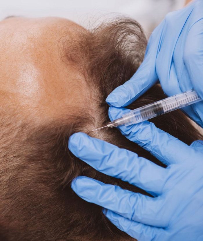 PRP Scalp Injections | Skin Deep Midtown Med Spa.