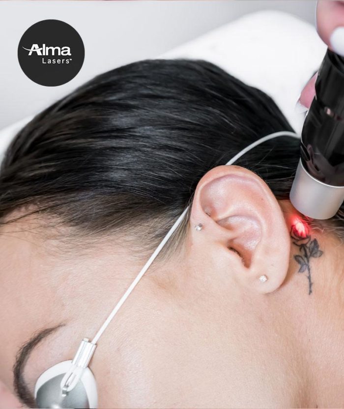 Laser Tattoo Removal | Skin Deep Midtown Med Spa.