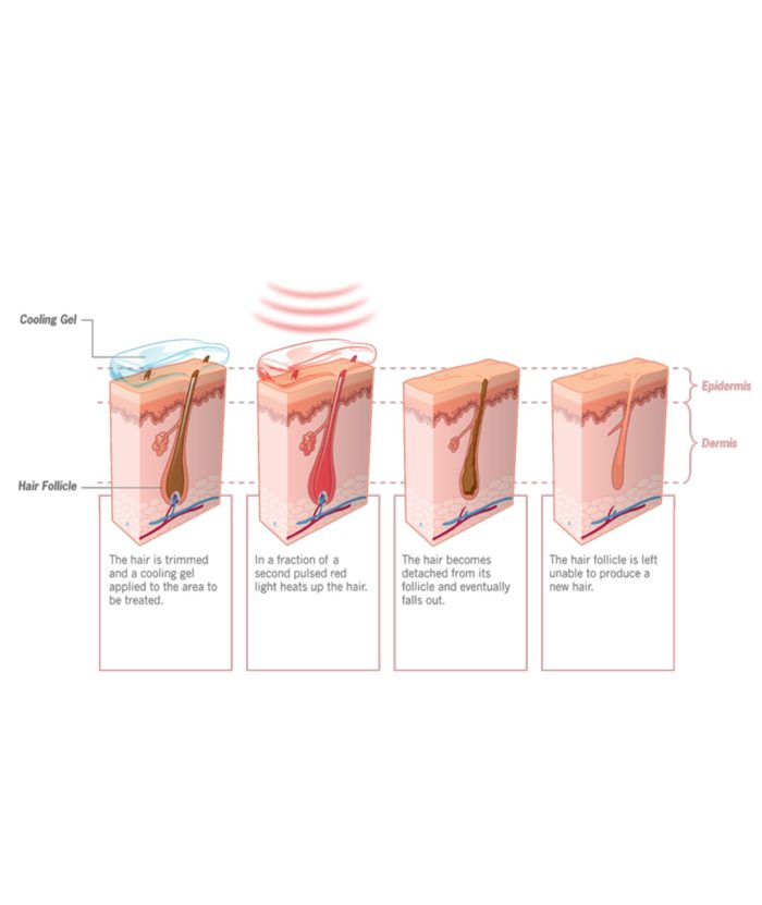 Laser Hair Removal | Skin Deep Midtown Med Spa.