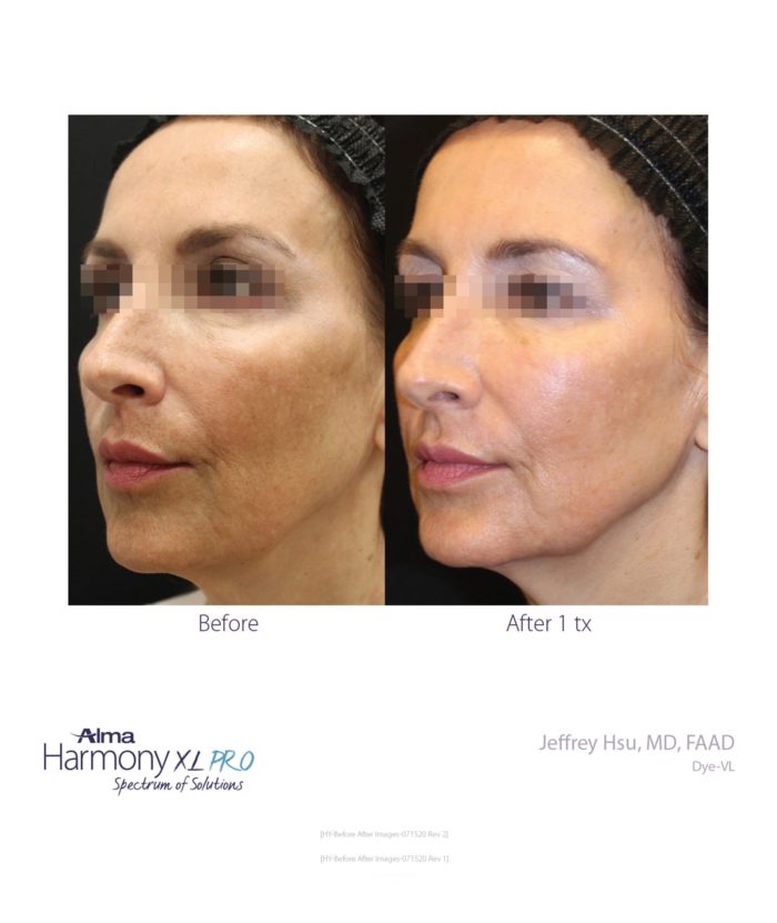 IPL Age | Scar | Spot | Skin Deep Midtown Med Spa.