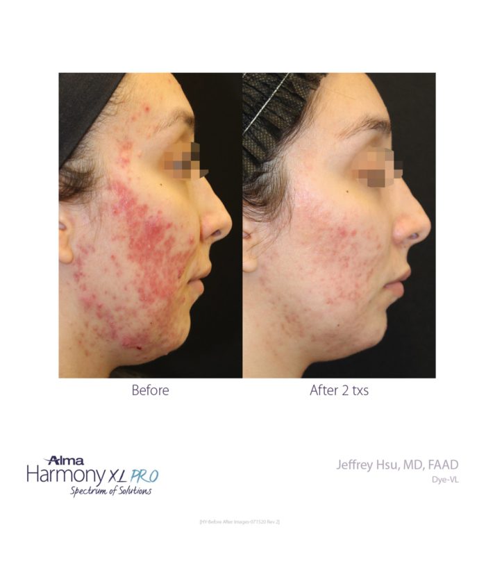 IPL Age | Scar | Spot | Skin Deep Midtown Med Spa.