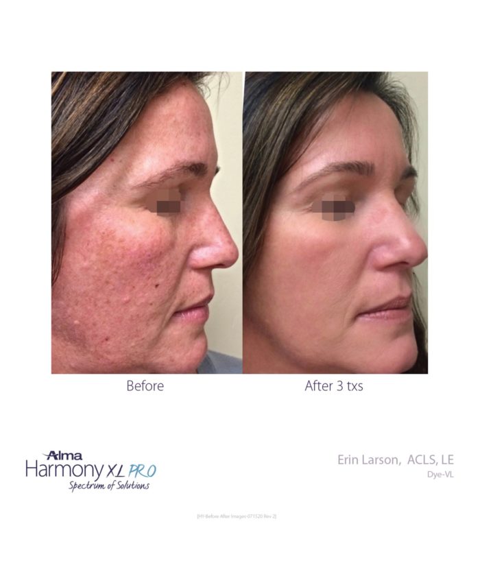 IPL Age | Scar | Spot | Skin Deep Midtown Med Spa.