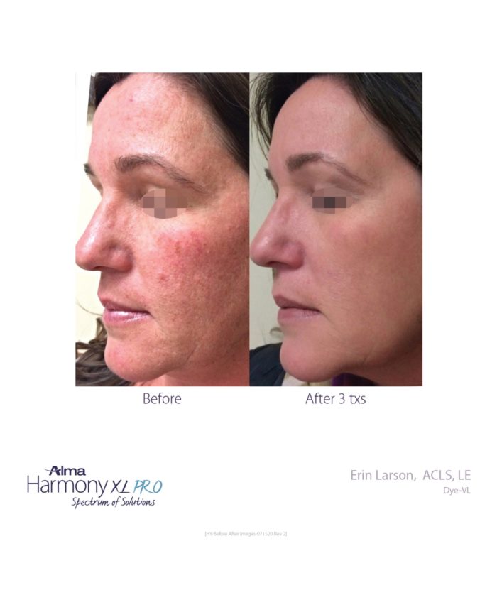 IPL Age | Scar | Spot | Skin Deep Midtown Med Spa.