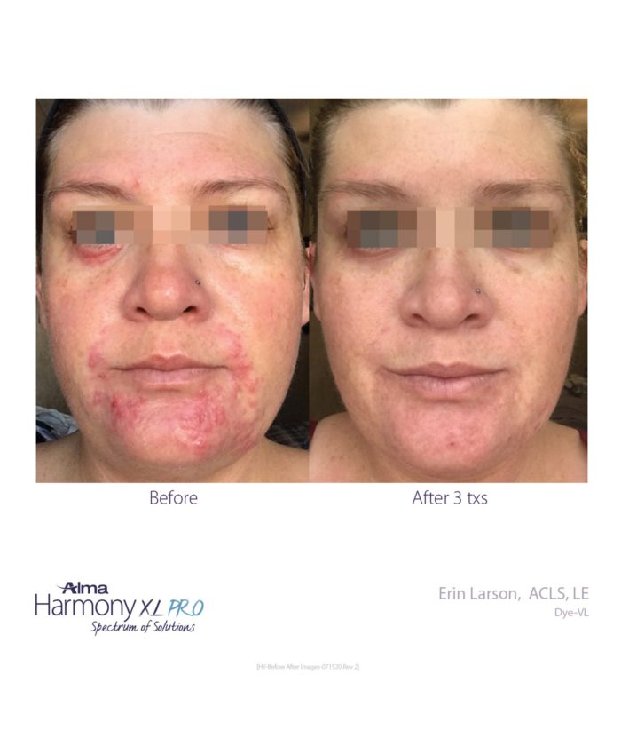 IPL Age | Scar | Spot | Skin Deep Midtown Med Spa.