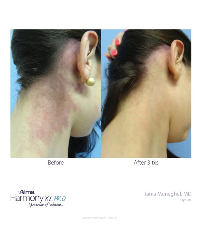 IPL Age | Scar | Spot | Skin Deep Midtown Med Spa.