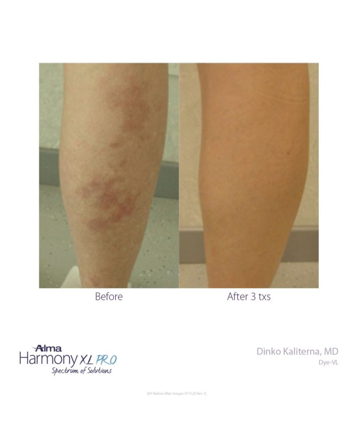 IPL Age | Scar | Spot | Skin Deep Midtown Med Spa.