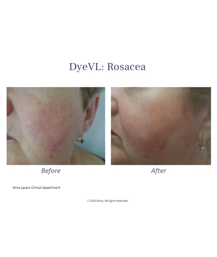 IPL Age | Scar | Spot | Skin Deep Midtown Med Spa.