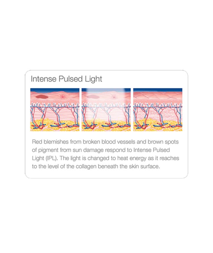 IPL Age | Scar | Spot | Skin Deep Midtown Med Spa.