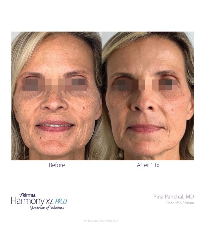 Clear Lift Skin Tightening | Skin Deep Midtown Med Spa.