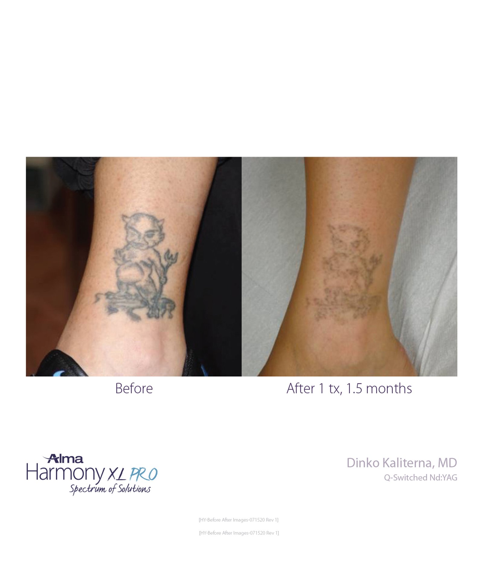 Laser Tattoo Removal | Skin Deep NYC