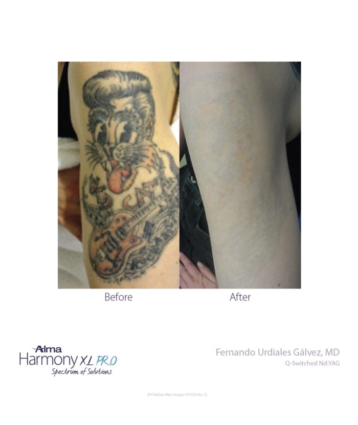 Laser Tattoo Removal | Skin Deep Midtown Med Spa.