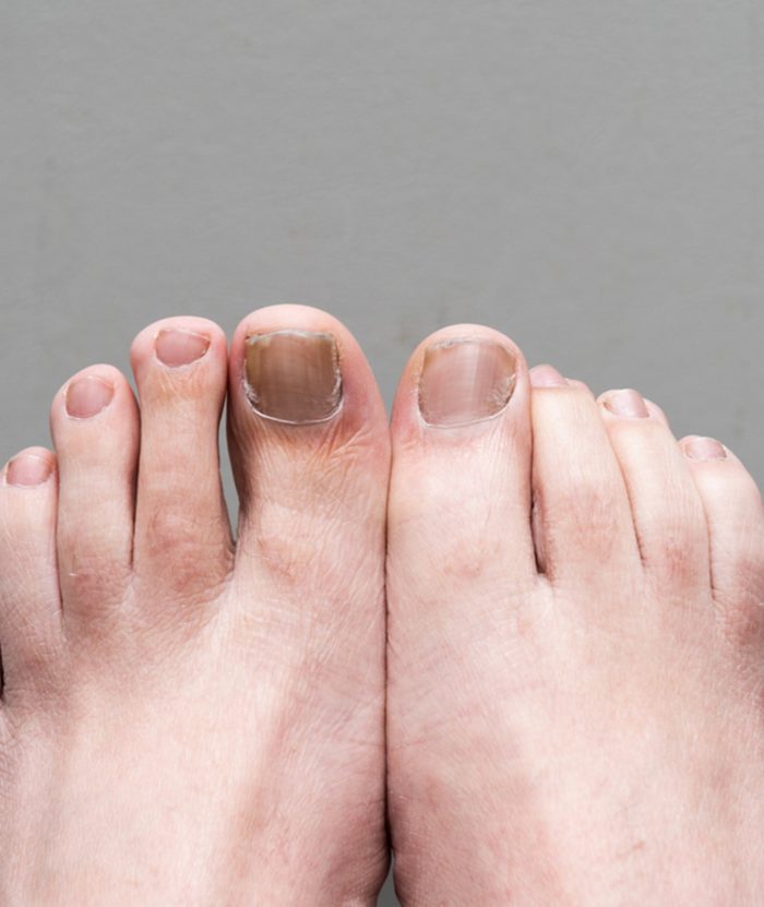 Nail Fungus | Skin Deep Midtown Med Spa.