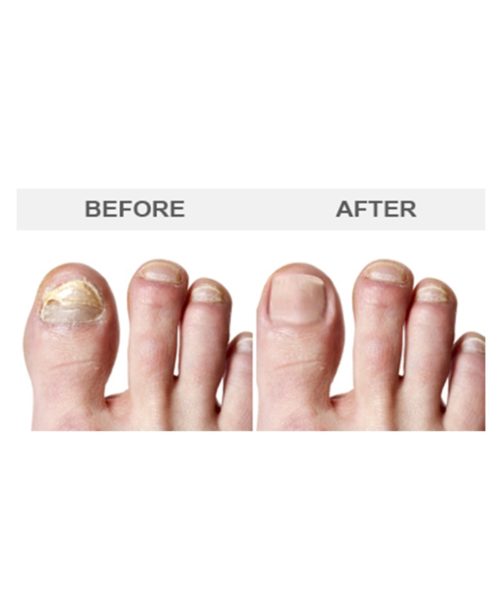 Nail Fungus | Skin Deep Midtown Med Spa.