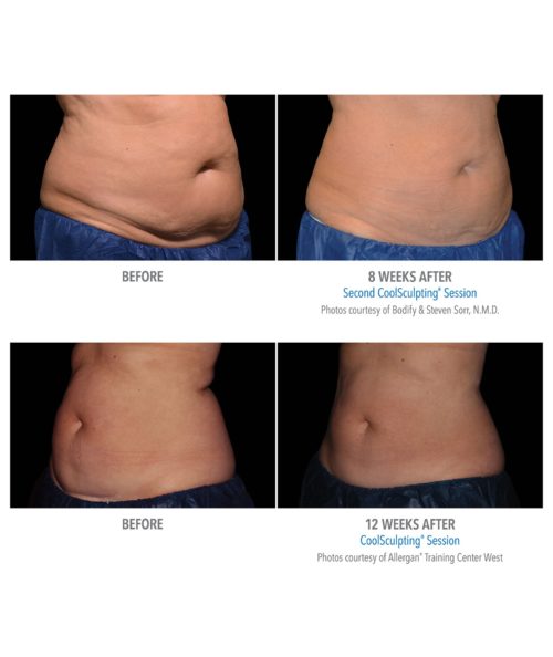 Coolsculpting – Body Contouring | Skin Deep Midtown Med Spa.