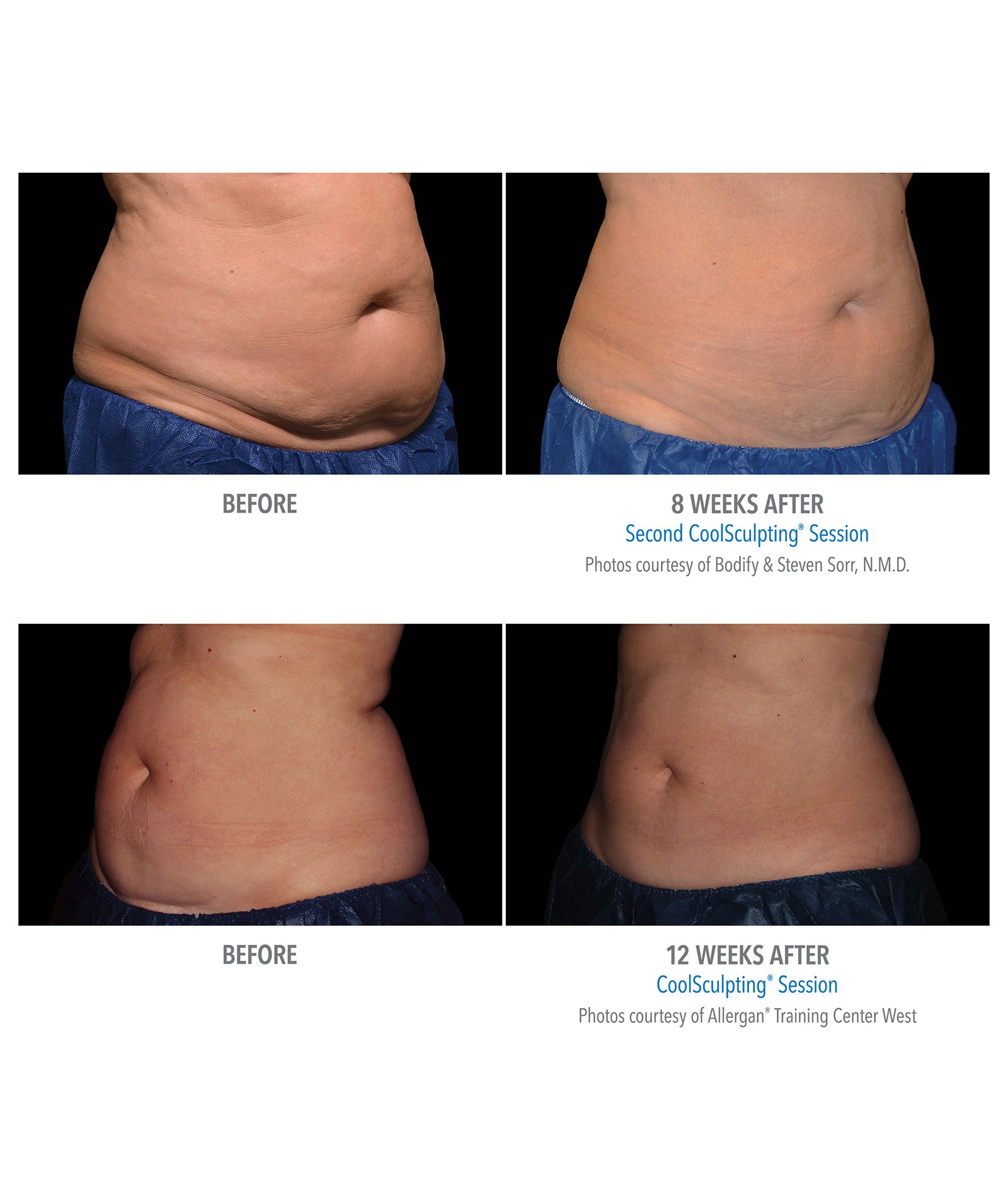 Coolsculpting – Body Contouring by Skin Deep Midtown Med Spa