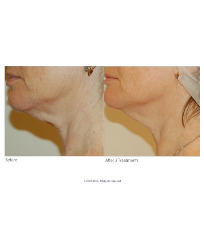 Clear Lift Skin Anti Aging | Skin Deep Midtown Med Spa.