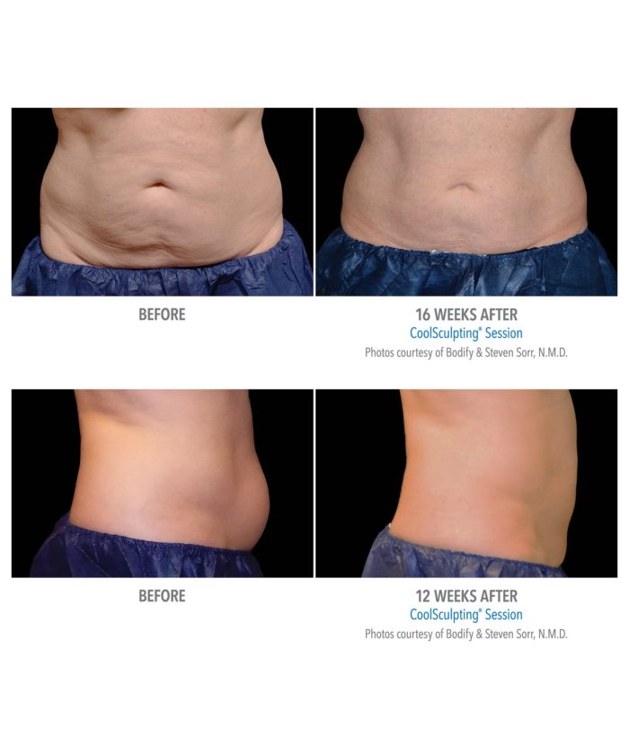 Coolsculpting – Body Contouring | Skin Deep Midtown Med Spa.