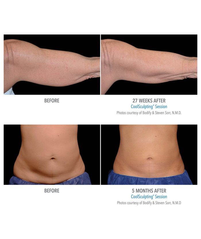 Coolsculpting – Body Contouring | Skin Deep Midtown Med Spa.