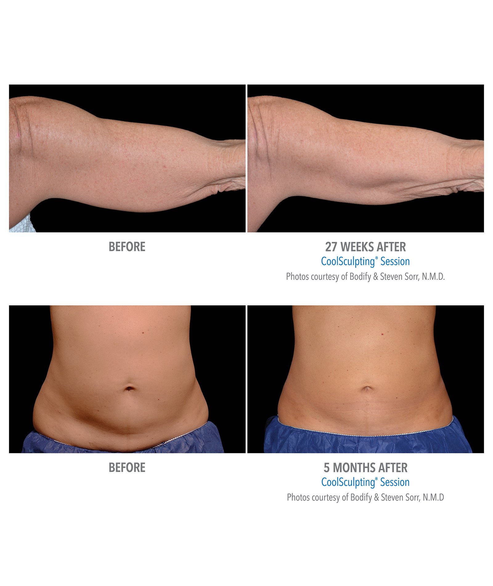 Coolsculpting – Body Contouring by Skin Deep Midtown Med Spa