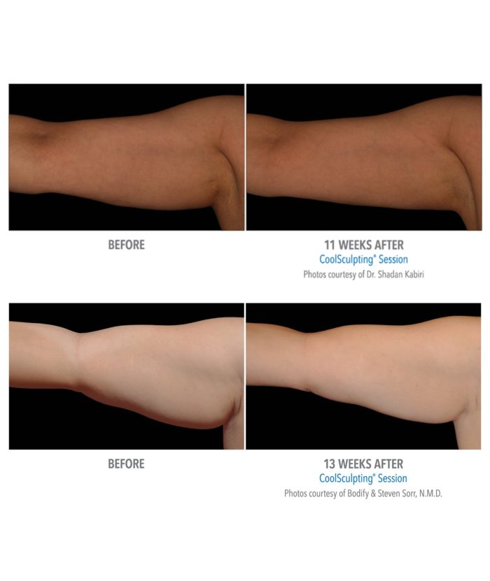 Coolsculpting – Body Contouring | Skin Deep Midtown Med Spa.