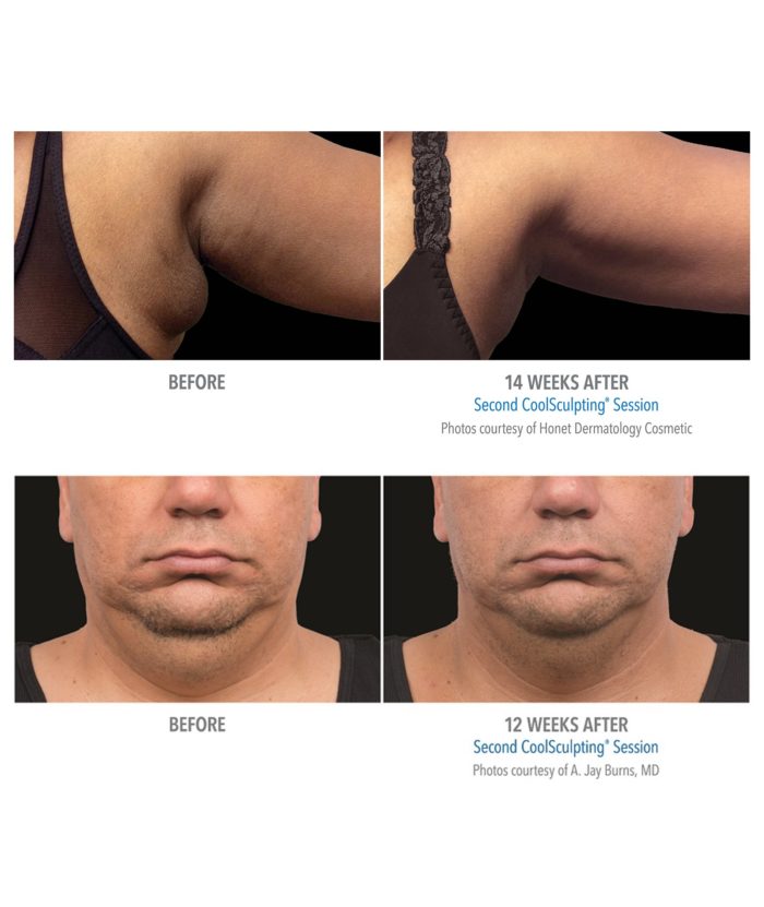 Coolsculpting – Body Contouring | Skin Deep Midtown Med Spa.