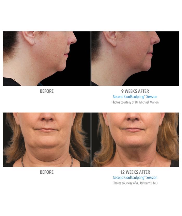 Coolsculpting – Body Contouring | Skin Deep Midtown Med Spa.