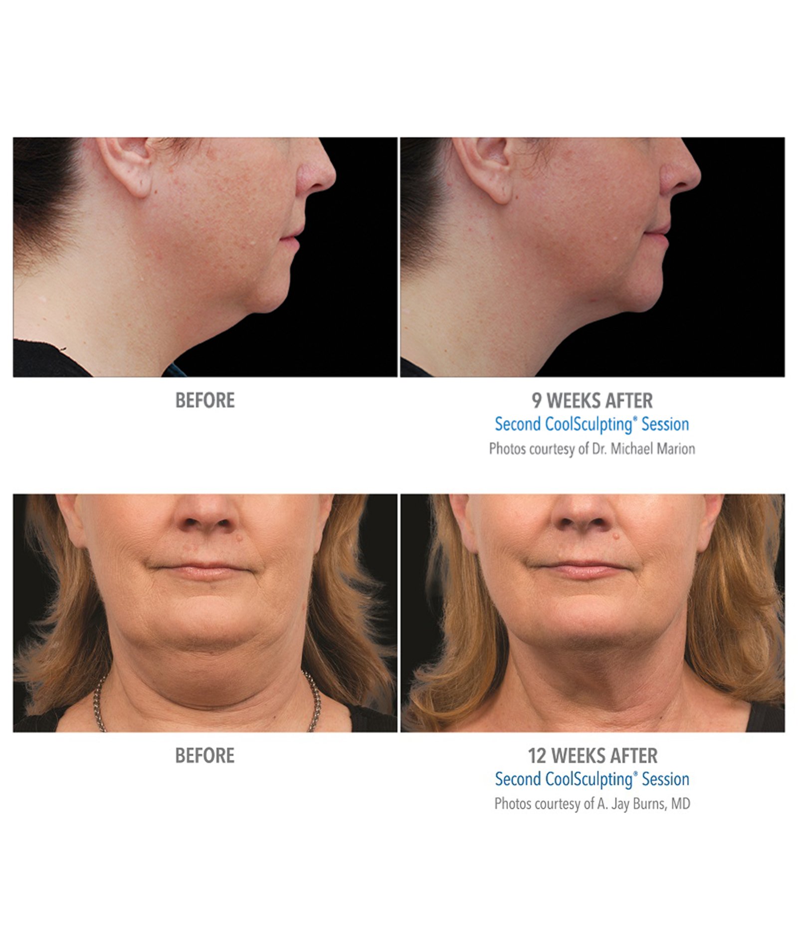 Coolsculpting – Body Contouring by Skin Deep Midtown Med Spa