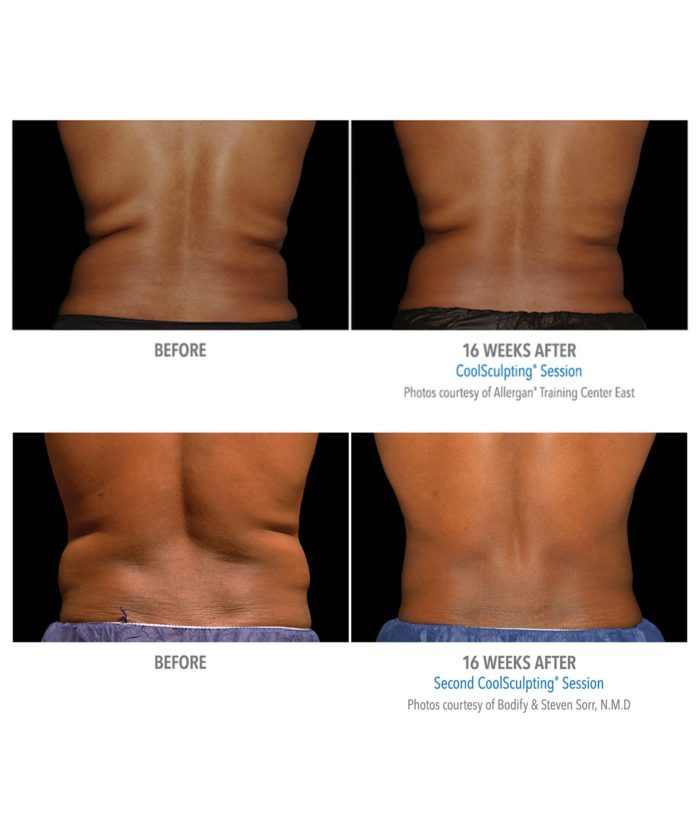 Coolsculpting – Body Contouring | Skin Deep Midtown Med Spa.