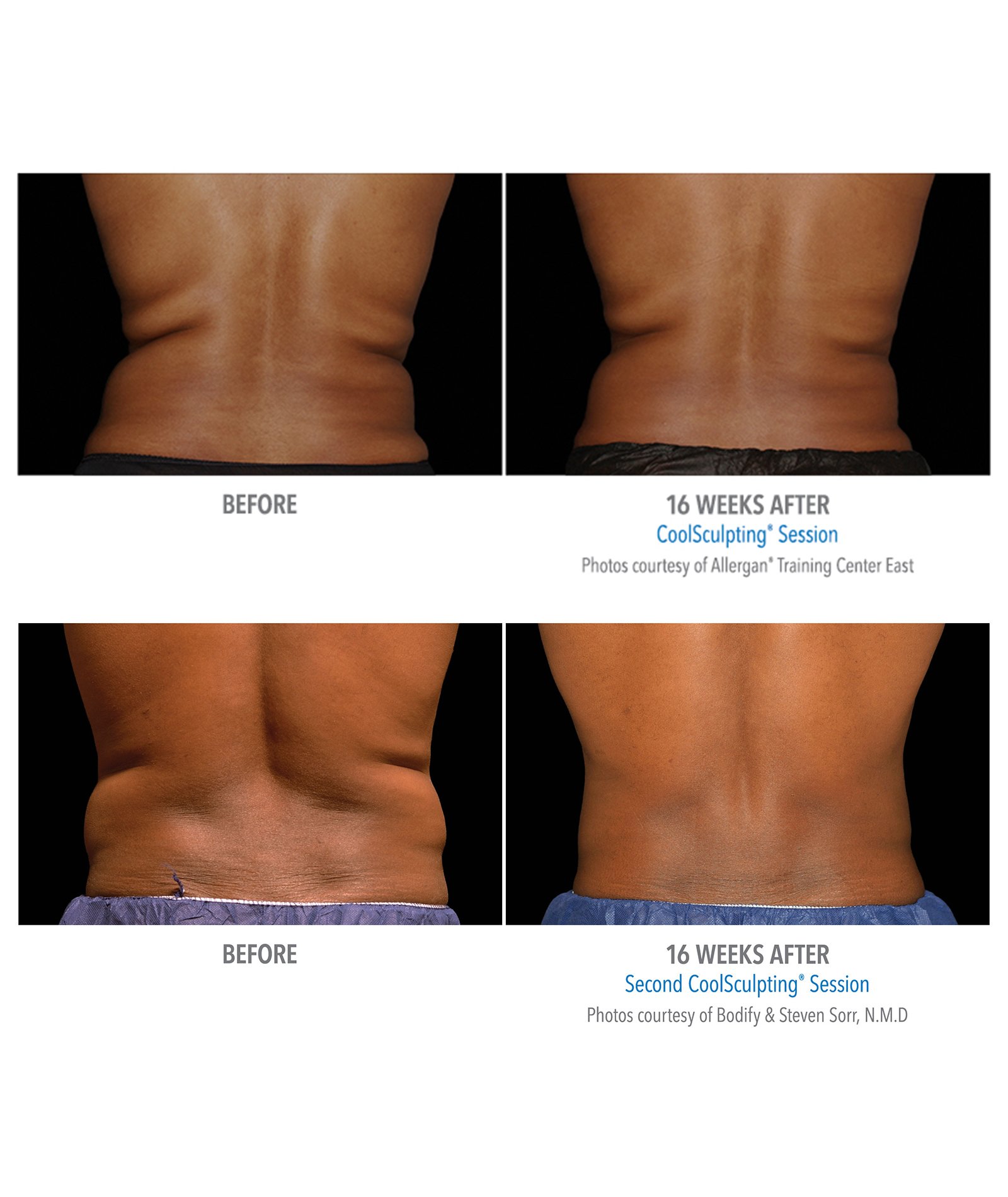 Coolsculpting – Body Contouring