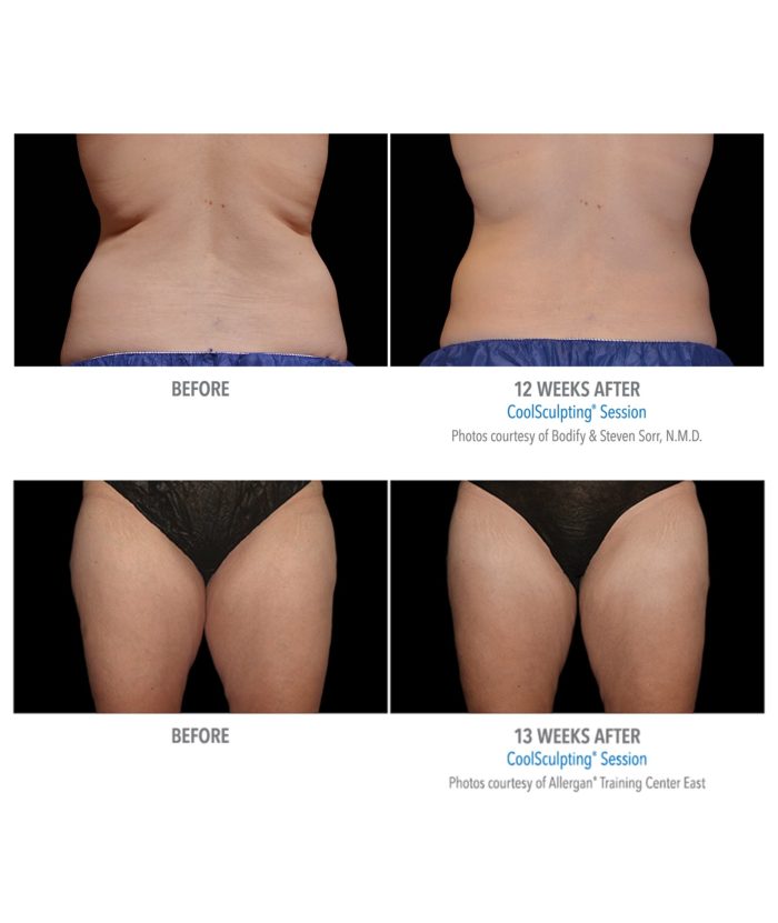 Coolsculpting – Body Contouring | Skin Deep Midtown Med Spa.