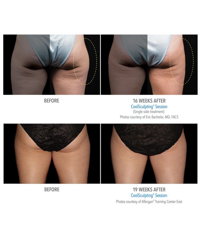 Coolsculpting – Body Contouring | Skin Deep Midtown Med Spa.